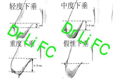 乳房下垂(一): 原因及分度